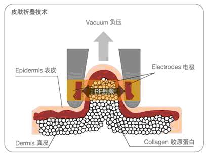 工作原理示意图-丹意达M6减肥设备