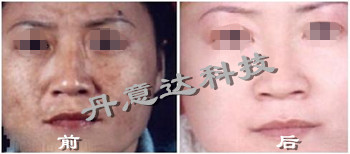 E光美容仪|激光美容仪