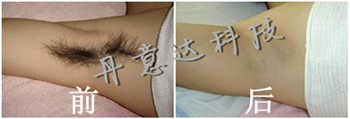 E光美容仪|激光美容仪